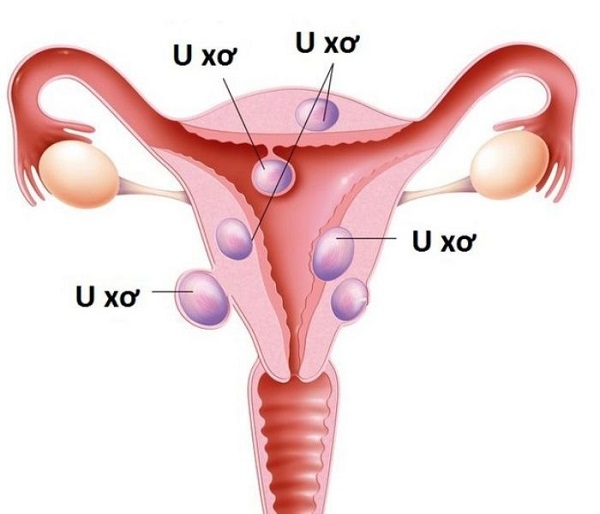 U xơ tử cung, u nang buồng trứng gây ra tiểu đau rát sau quan hệ ở nữ giới