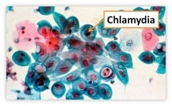 bệnh chlamydia, hình ảnh bệnh chlamydia, bệnh chlamydia có chữa khỏi được không, bệnh chlamydia ở nam giới, bệnh chlamydia o nam gioi, thời gian ủ bệnh chlamydia, thuốc chữa bệnh chlamydia, chlamydia, chlamydia treatment, chlamydia symptoms, symptoms of chlamydia, chlamydia how to treat