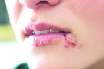 herpes sinh dục, herpes sinh dục triệu chứng, bệnh herpes sinh dục, herpes sinh dục biểu hiện, herpes sinh dục là gì, herpes sinh dục có nguy hiểm không, herpes sinh dục bôi thuốc gì, herpes sinh dục nam, herpes sinh dục là bệnh gì, thuốc chữa bệnh herpes sinh dục
