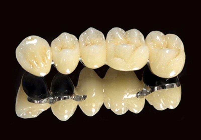 Răng sứ có mấy loại, ưu và nhược điểm | Vinmec