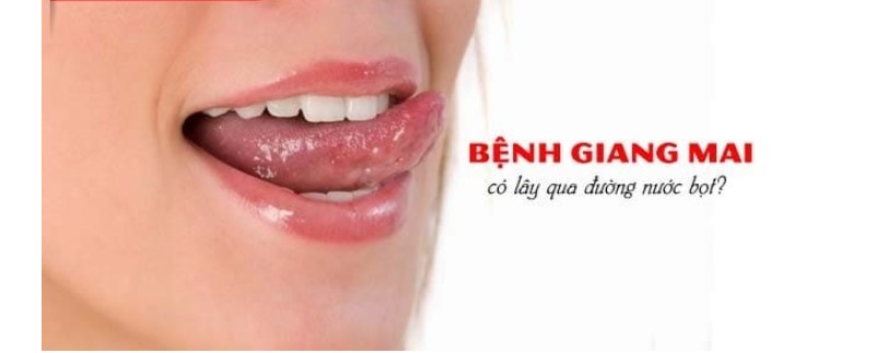 bệnh giang mai ở miệng, hình ảnh bệnh giang mai ở miệng, bệnh giang mai, giang mai, bệnh giang mai là gì, bệnh giang mai la gi, bệnh giang mai ở nữ, bệnh giang mai có chữa được không, bệnh giang mai lây qua đường nào, bệnh giang mai có ngứa không, bệnh giang mai là bệnh gì, thời gian ủ bệnh giang mai