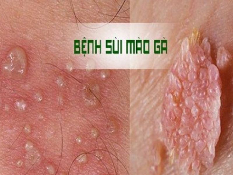 , sùi mào gà và cách chữa trị, sùi mào gà là gì, sùi mào gà ở lưỡi, sùi mào gà ở nữ, sùi mào gà ở nam, sùi mào gà nguyên nhân, sùi mào gà có nguy hiểm không