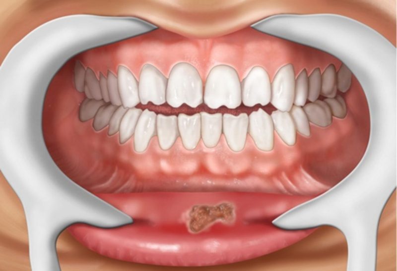bệnh giang mai ở miệng, hình ảnh bệnh giang mai ở miệng, bệnh giang mai, giang mai, bệnh giang mai là gì, bệnh giang mai la gi, bệnh giang mai ở nữ, bệnh giang mai có chữa được không, bệnh giang mai lây qua đường nào, bệnh giang mai có ngứa không, bệnh giang mai là bệnh gì, thời gian ủ bệnh giang mai