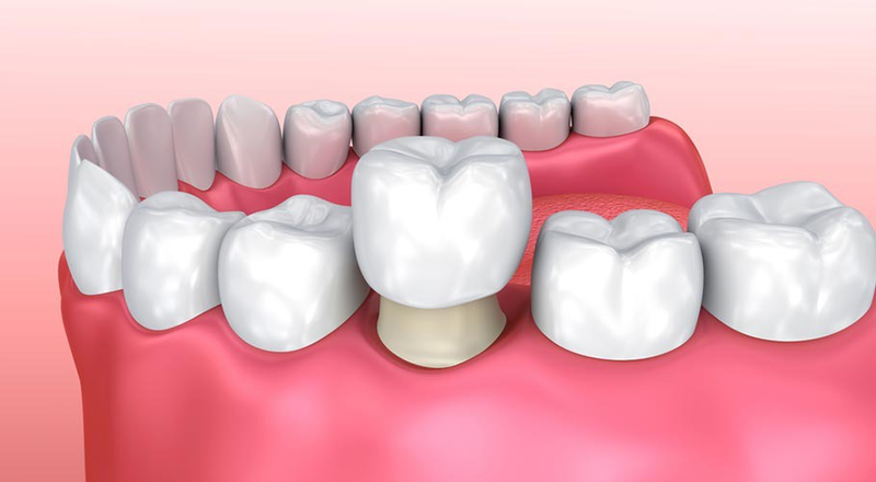 Bọc răng sứ có bền không? Quy trình bọc răng sứ an toàn