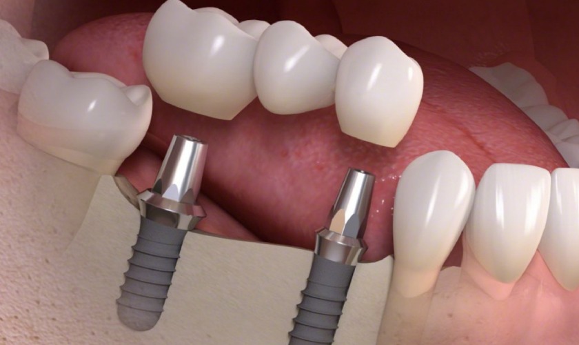 Cầu răng sứ trên implant