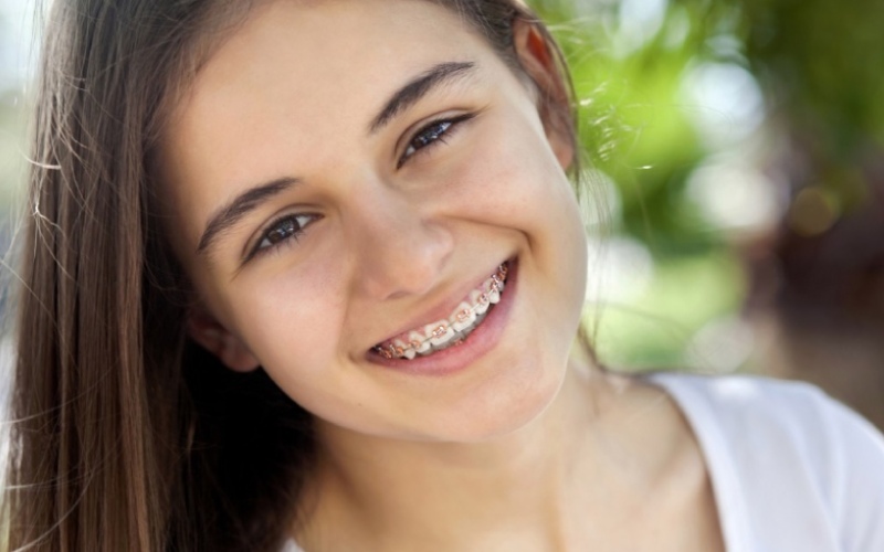 Chỉnh nha giúp răng đều, cải thiện chức năng ăn nhai